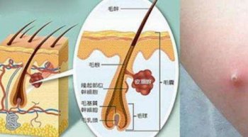 背上出现毛囊炎的原因