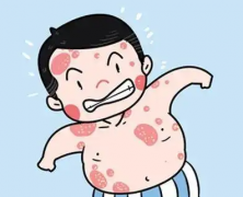牛皮癣复发怎么办