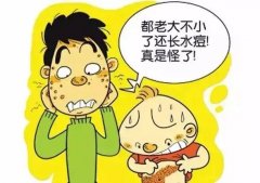 带状疱疹后遗神经痛治疗