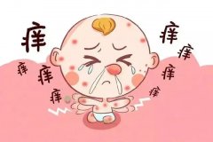 过敏性皮疹怎么消除