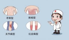 银屑病不治疗愈发严重怎么办