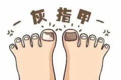 灰指甲是真菌感染吗